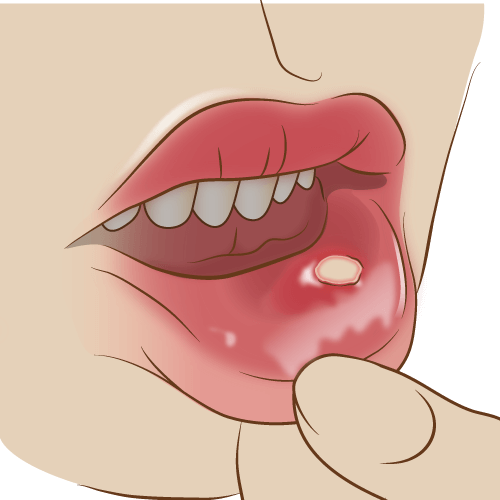 口内炎や、お口の中のできものについて