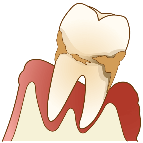 溝上歯科の歯周病治療について